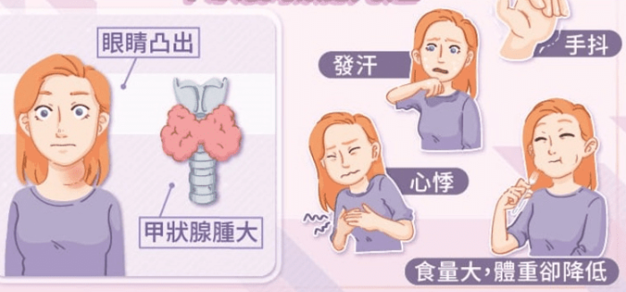 甲狀腺亢進原因